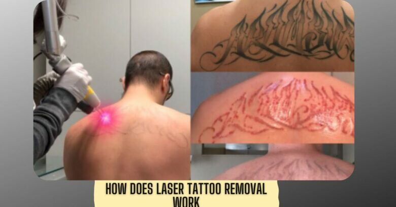 How Does Laser Tattoo Removal Work